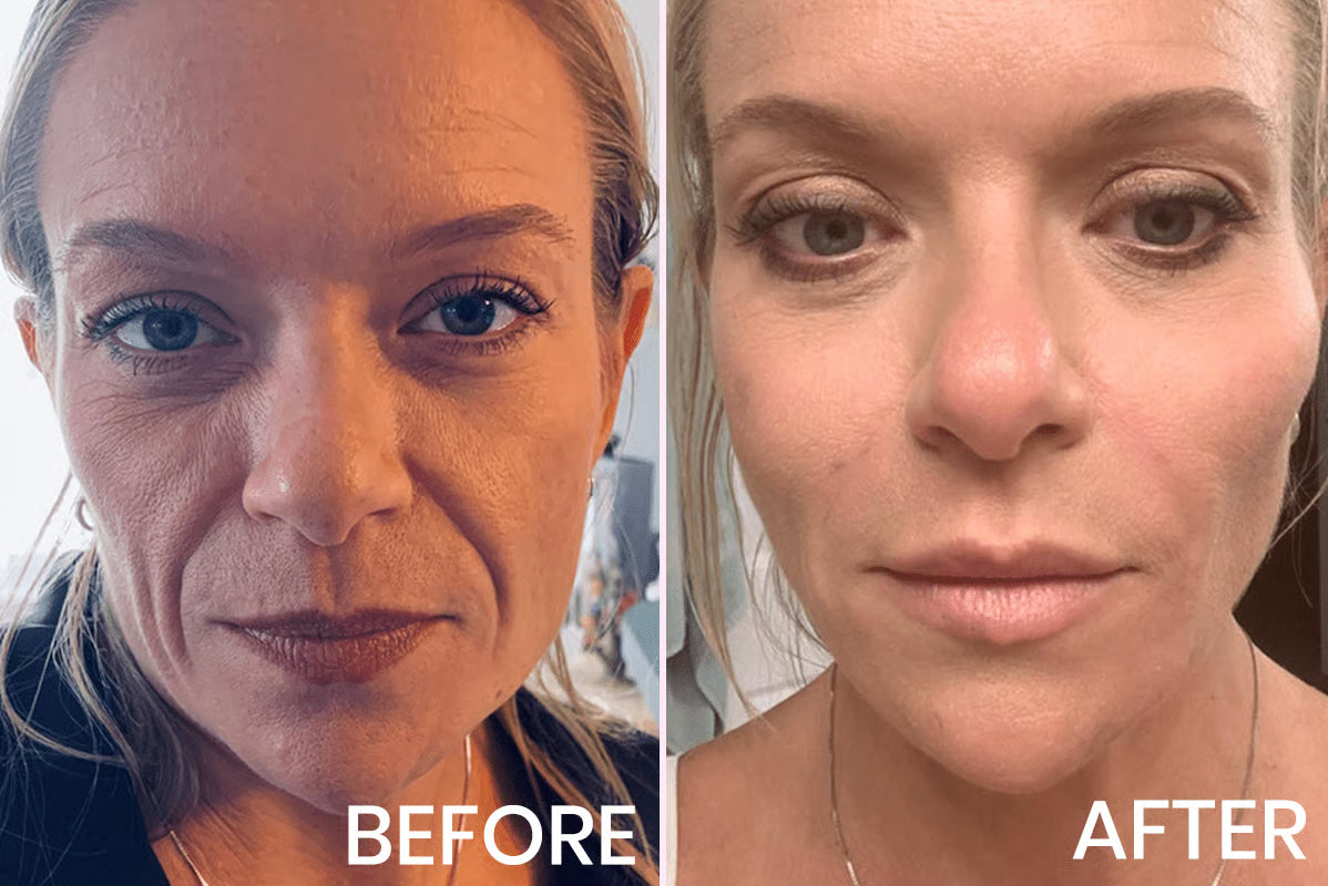 Cinta Facial de Elevación Invisible – Pack x100